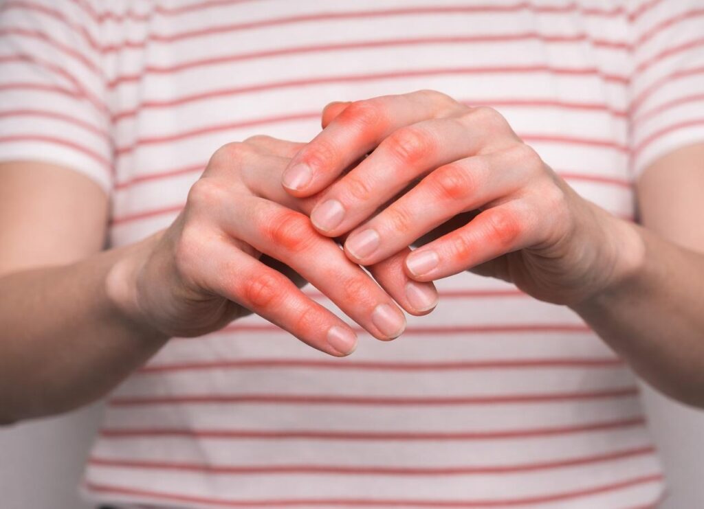 Dna moczanowa w rękach